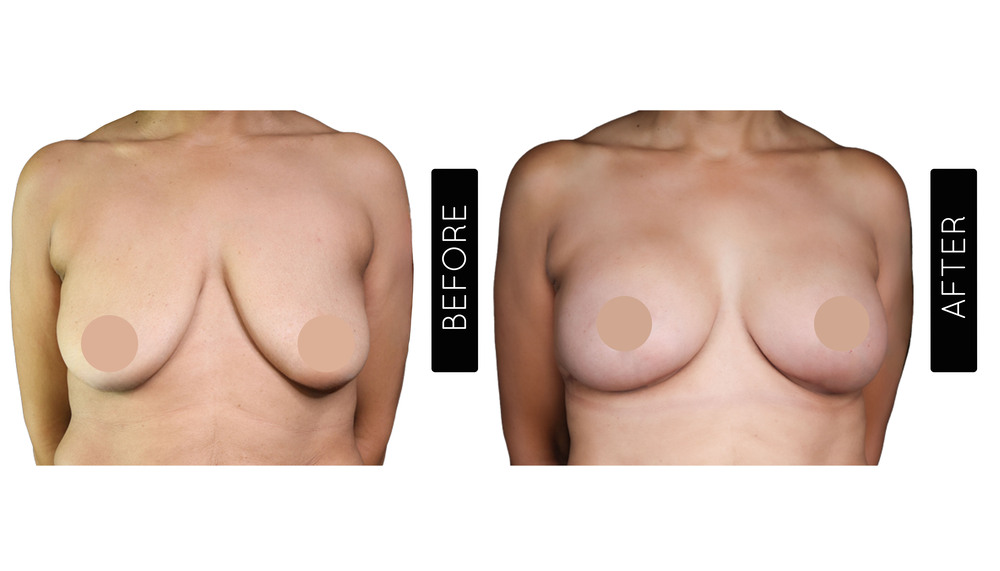 Breast Reduction Before and After