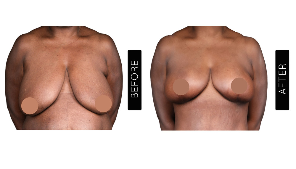 Breast Reduction Before and After