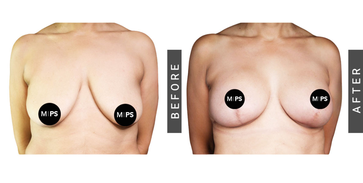 Breast Reduction Before and After