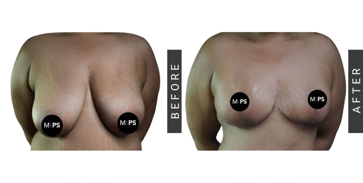 Breast Reduction Before and After