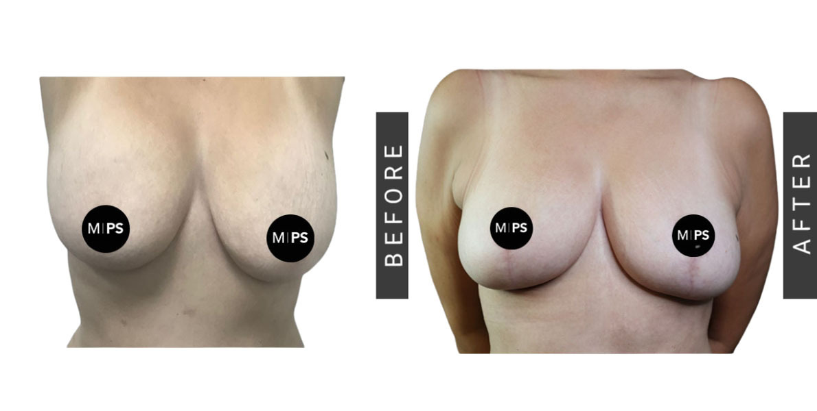 Breast Reduction Before and After