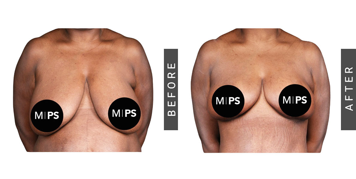 Breast Reduction Before and After
