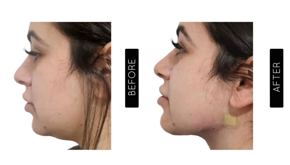 Liposucción de mentón Antes y después