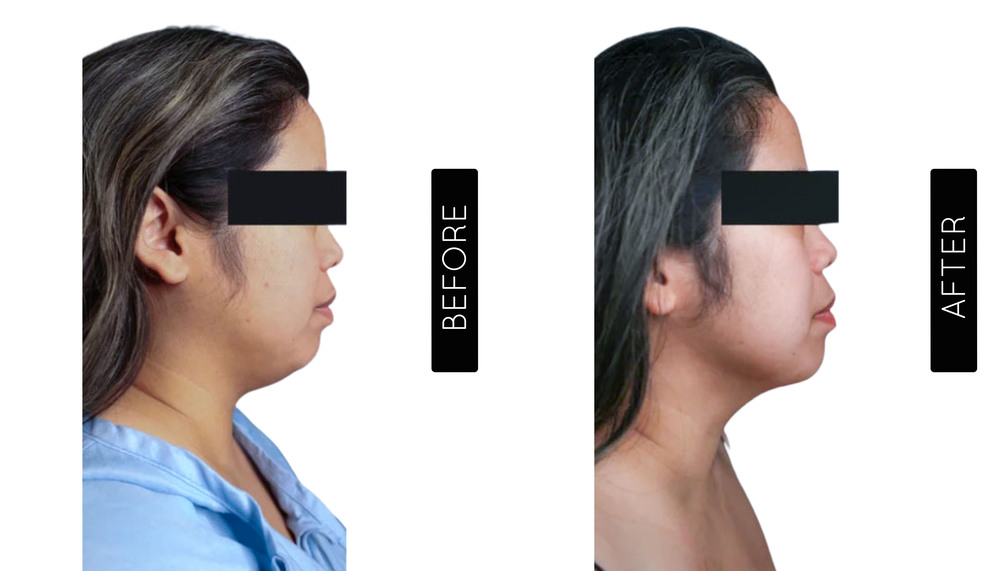 Liposucción de mentón Antes y después