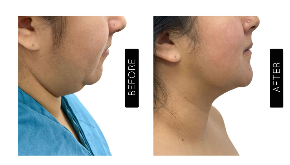 Liposucción de mentón Antes y después
