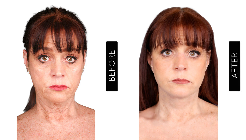 Facelift before and After