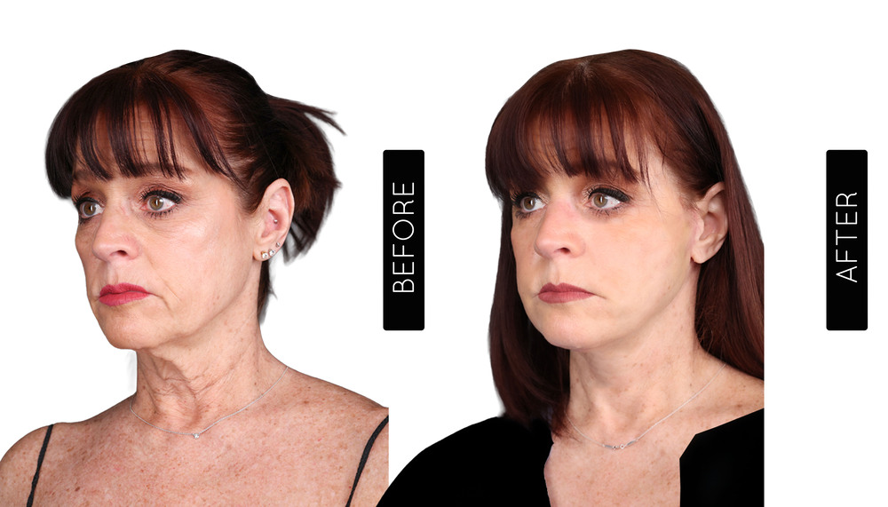 Facelift before and After