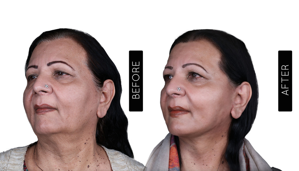 Facelift before and After