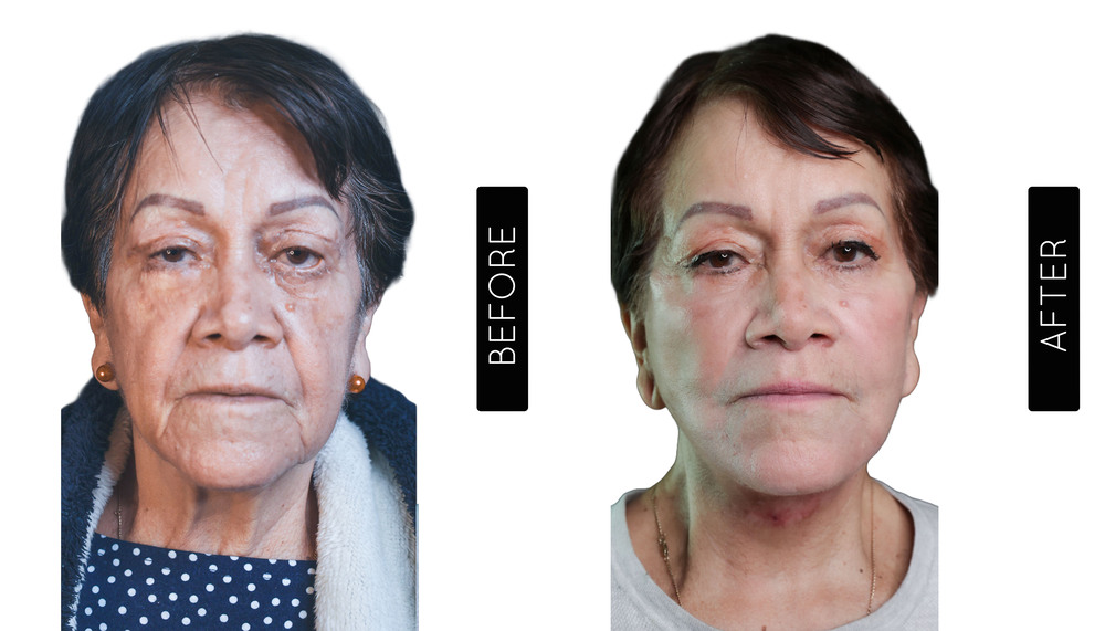 Facelift before and After