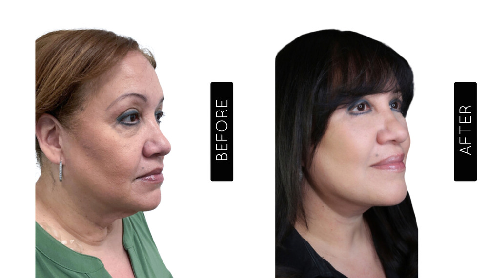 Facelift before and After