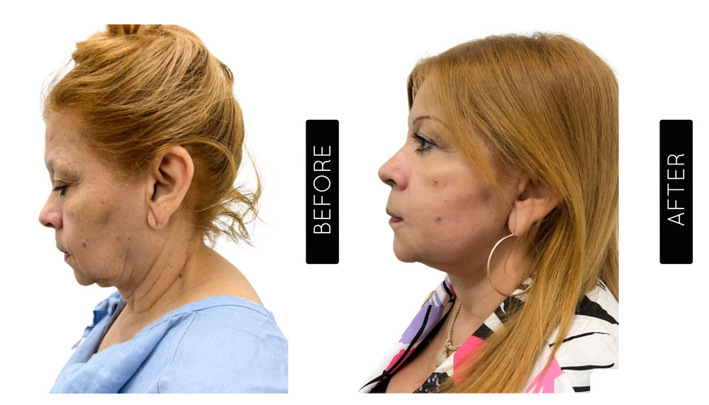 Facelift before and After