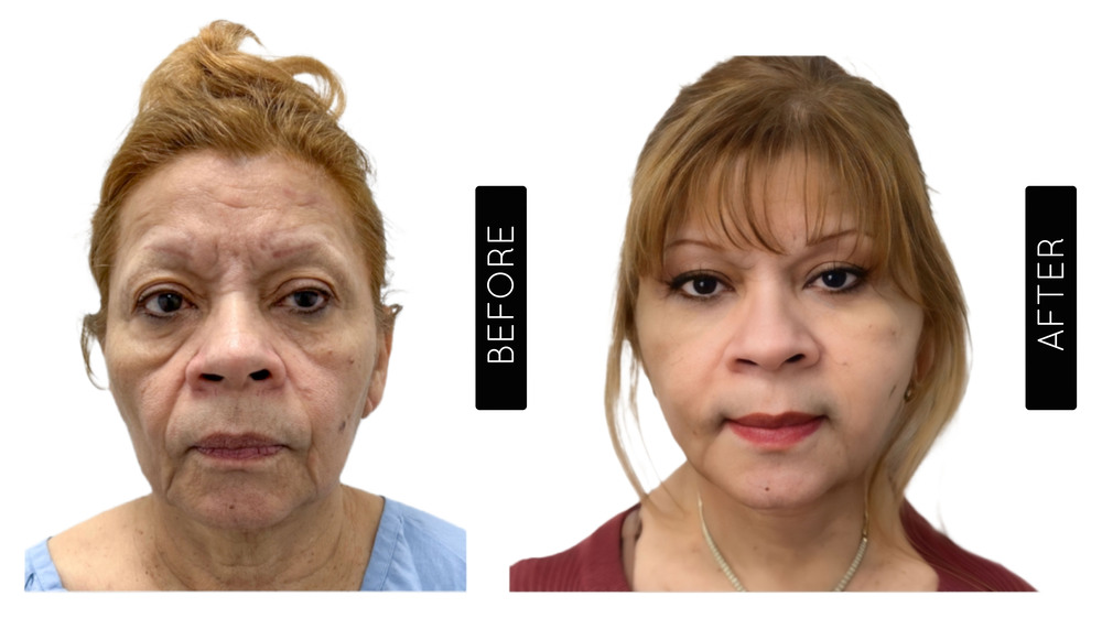 Facelift before and After