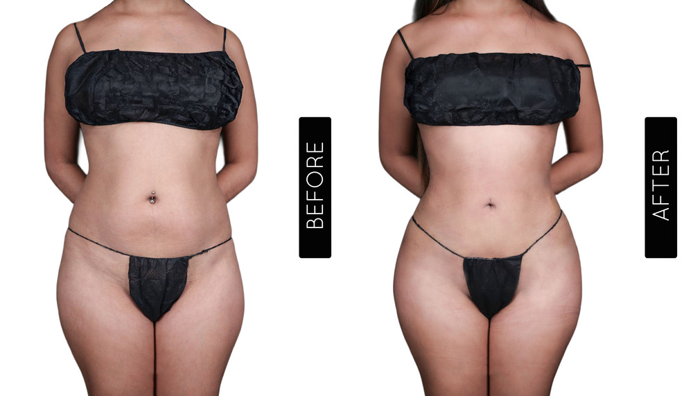 Abdomen Liposuction Before and After