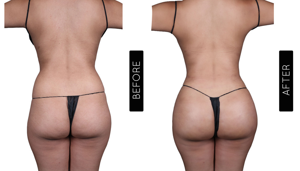 Abdomen Liposuction Before and After