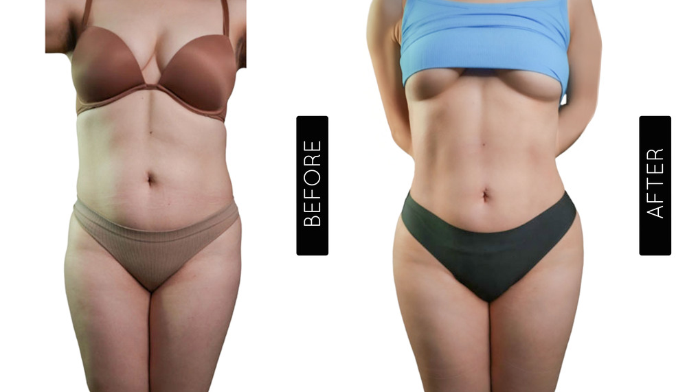 Abdomen Liposuction Before and After