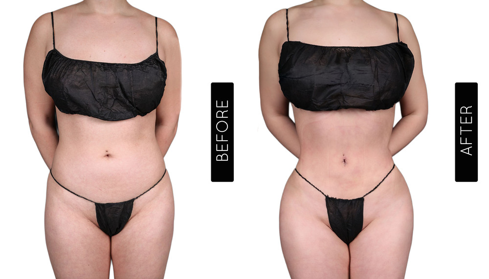 Abdomen Liposuction Before and After