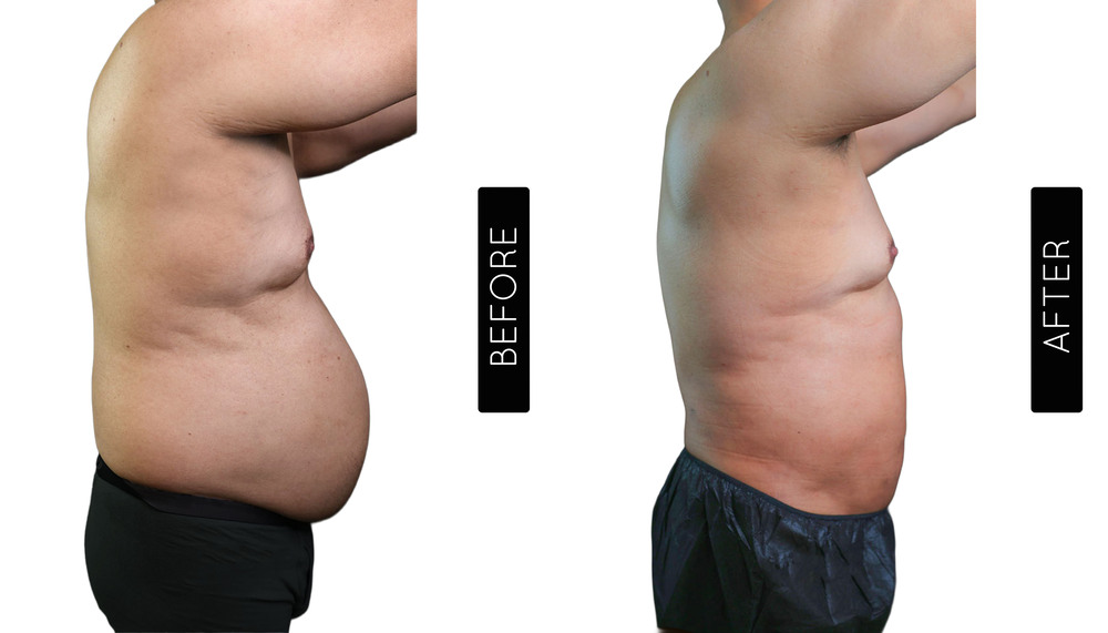Abdomen Liposuction Before and After