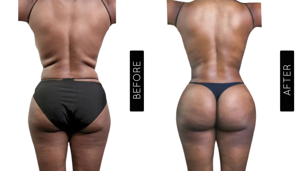 Abdomen Liposuction Before and After