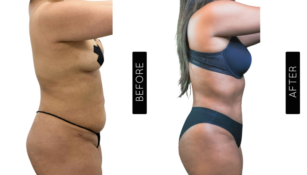 Abdomen Liposuction Before and After