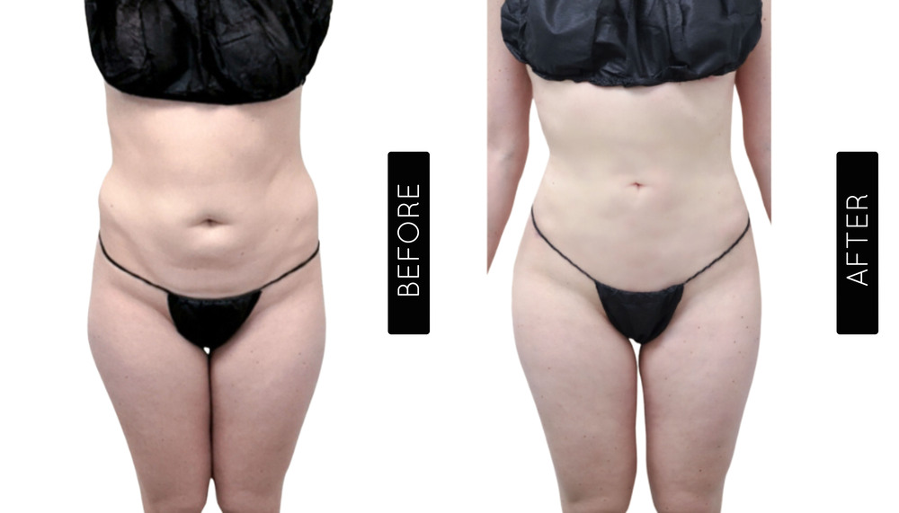 Abdomen Liposuction Before and After