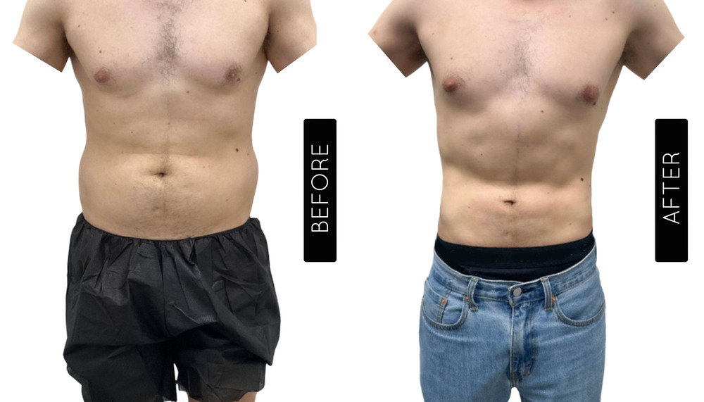 Abdomen Liposuction Before and After