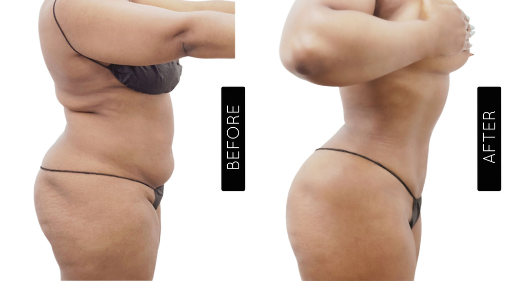 Abdomen Liposuction Before and After