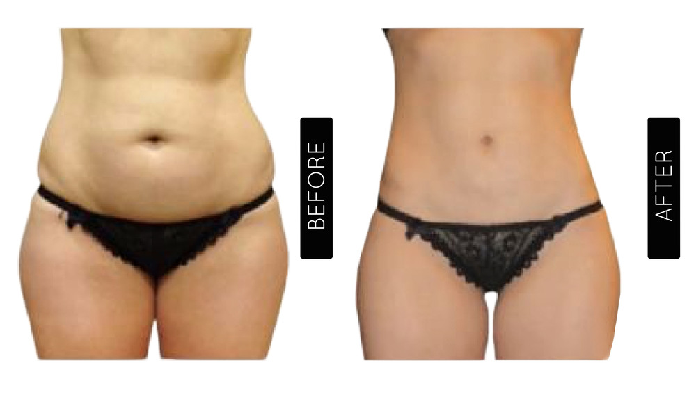 Abdomen Liposuction Before and After