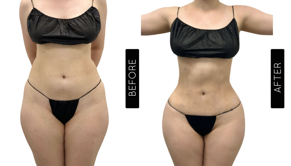 Abdomen Liposuction Before and After