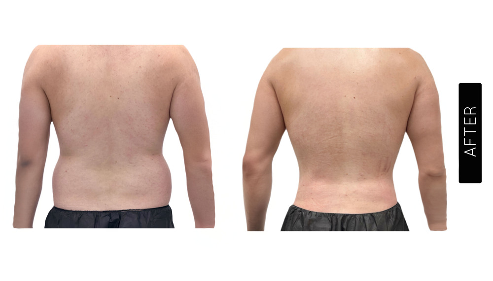 Abdomen Liposuction Before and After