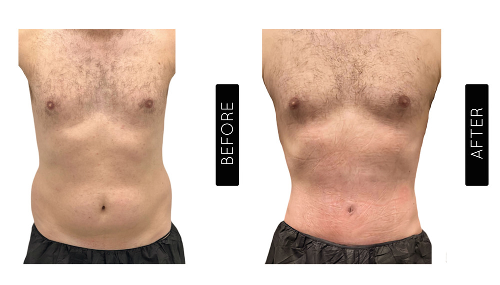 Abdomen Liposuction Before and After