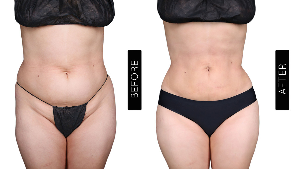 Abdomen Liposuction Before and After