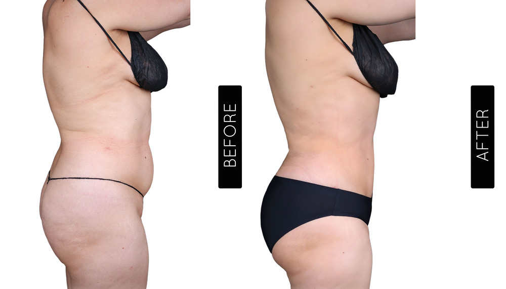 Abdomen Liposuction Before and After