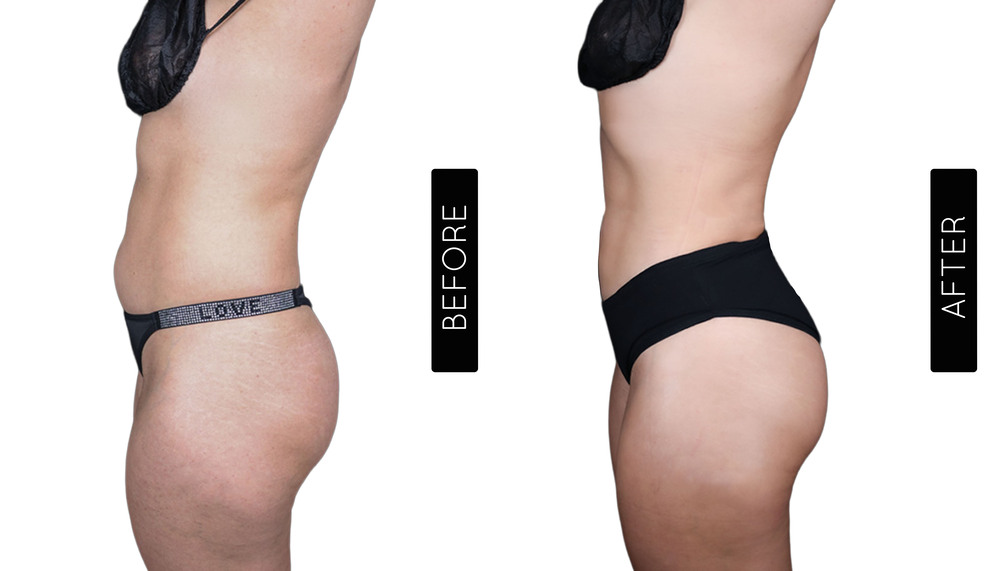 Abdomen Liposuction Before and After