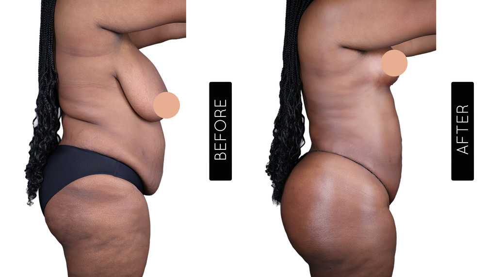 Mommy Makeover Before and After