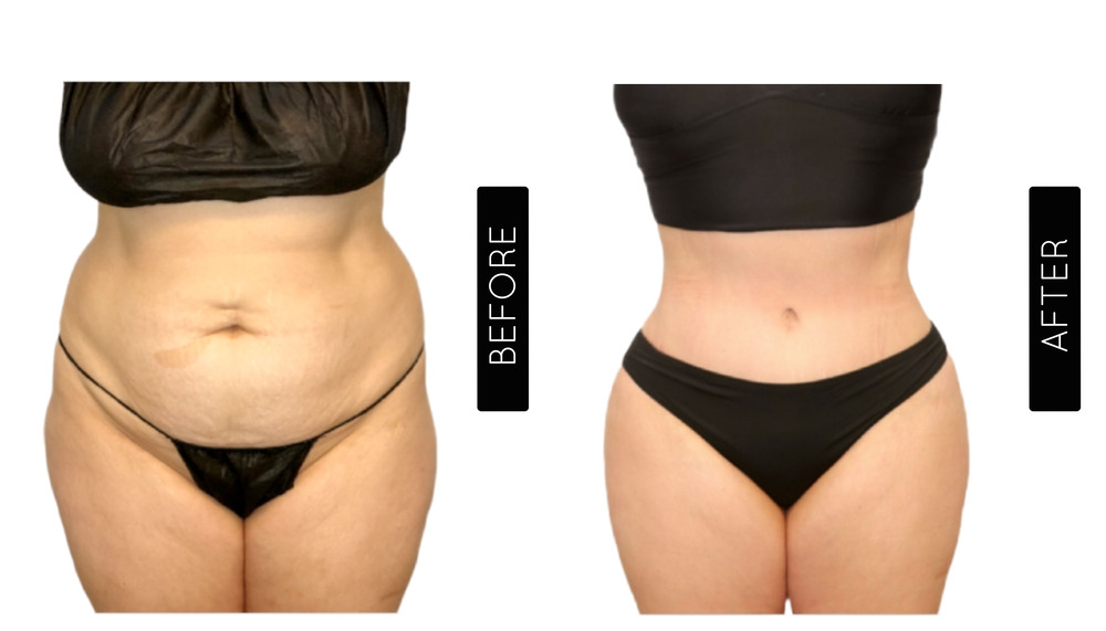 Mommy Makeover Antes y Después