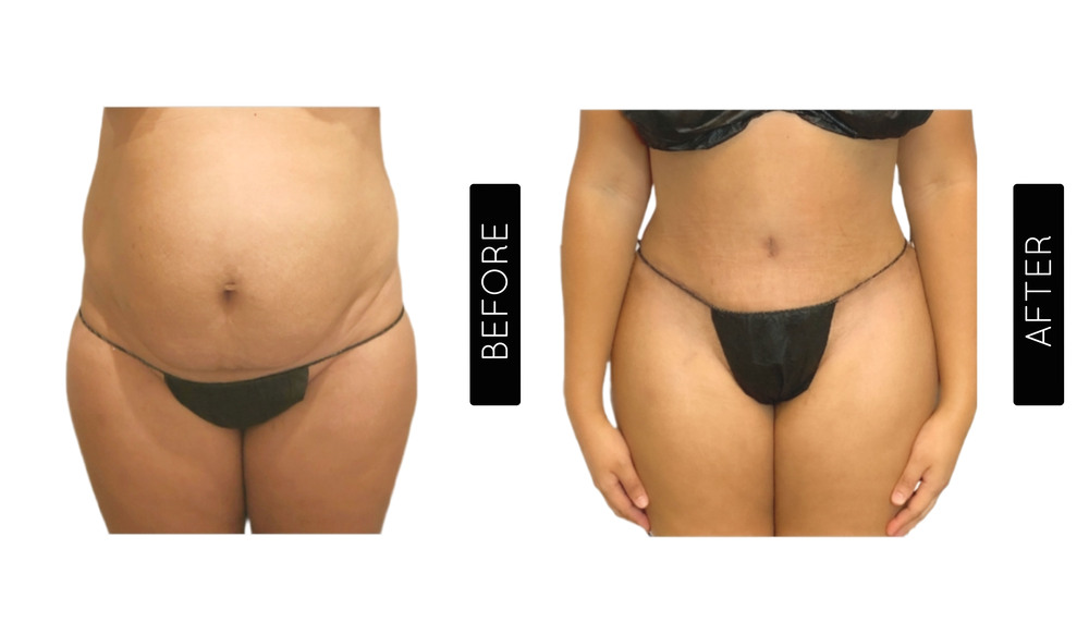 Mommy Makeover Antes y Después