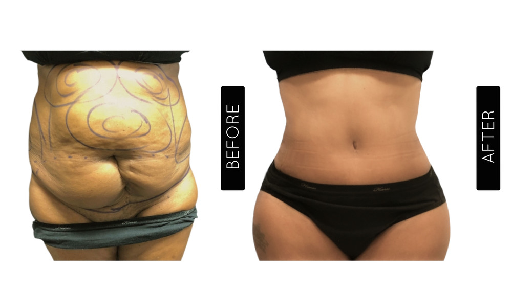 Mommy Makeover Antes y Después