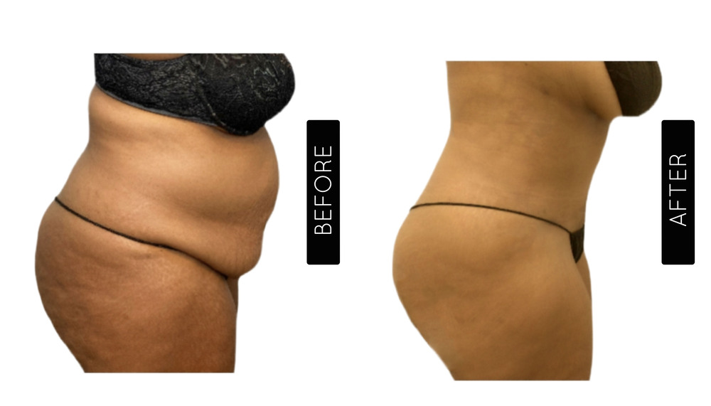 Mommy Makeover Antes y Después