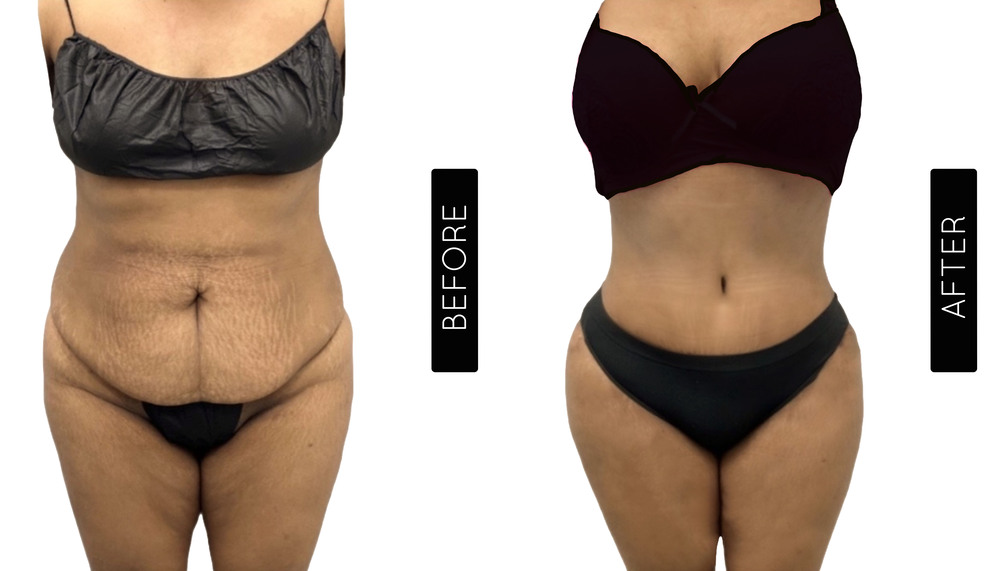 Mommy Makeover Antes y Después