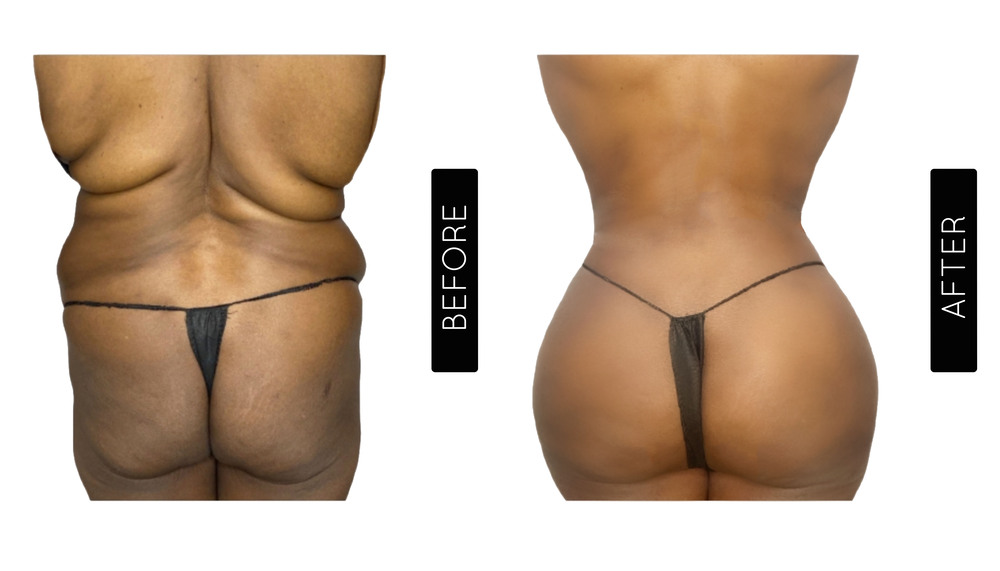 Mommy Makeover Antes y Después