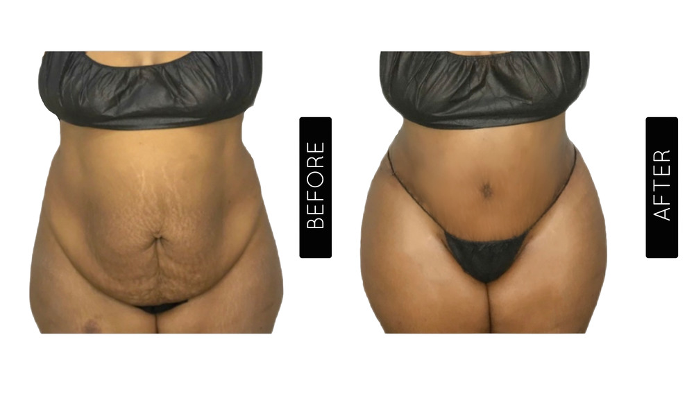 Mommy Makeover Antes y Después