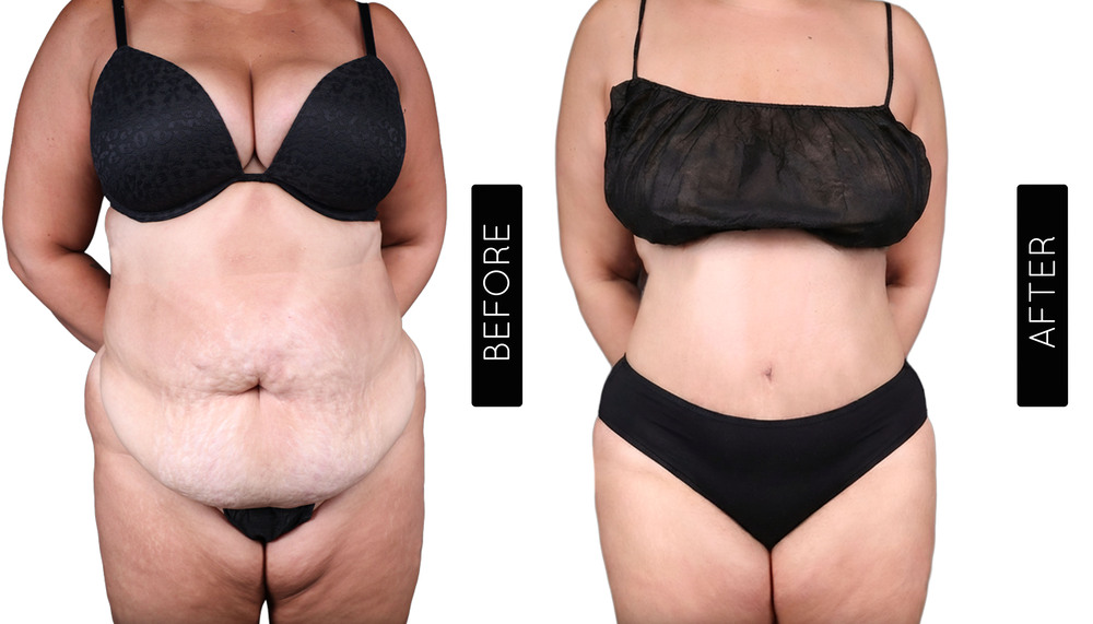 Mommy Makeover Before and After