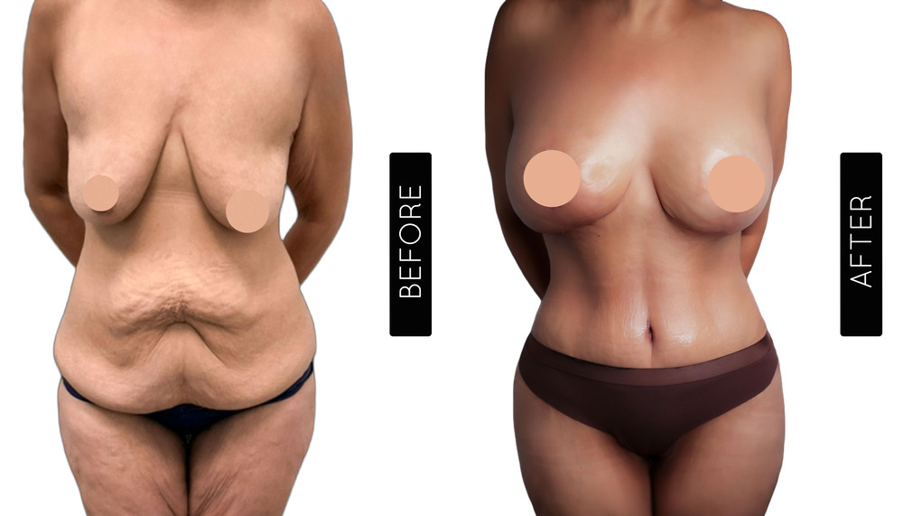 Mommy Makeover Antes y Después