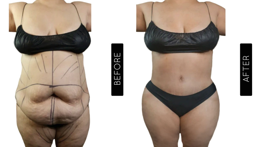 Mommy Makeover Antes y Después