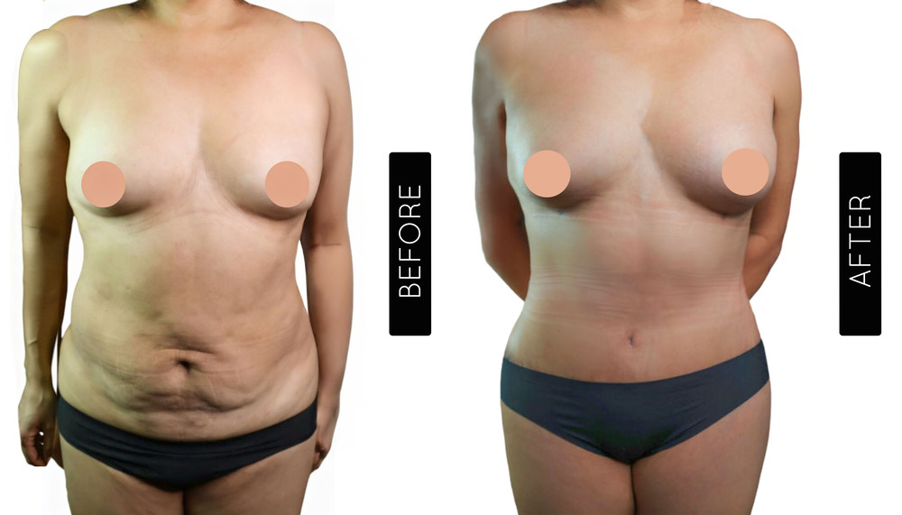 Mommy Makeover Antes y Después