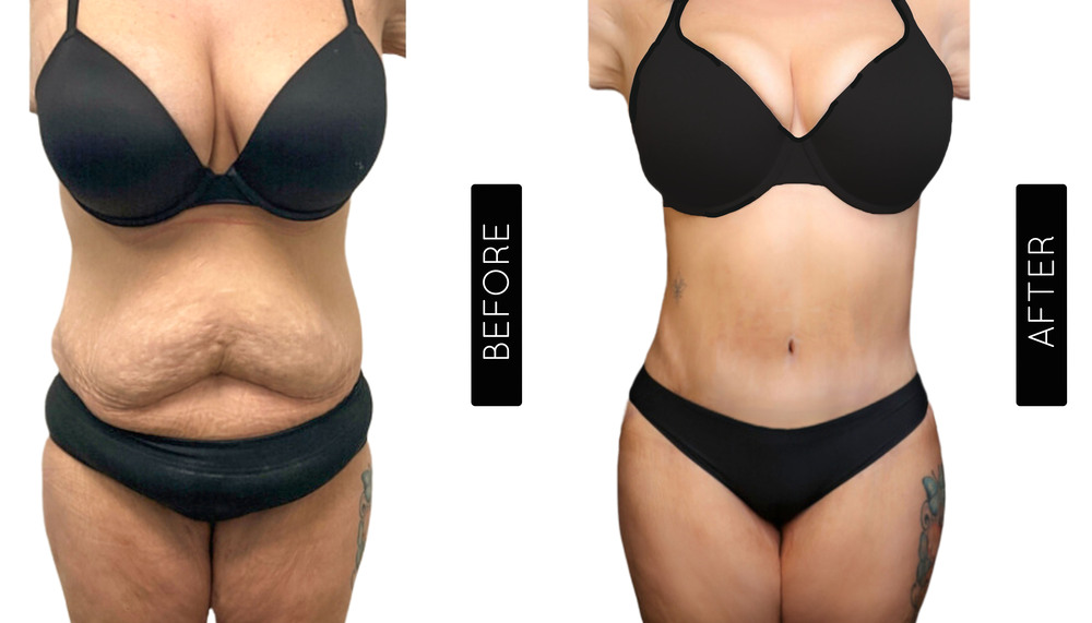 Mommy Makeover Antes y Después