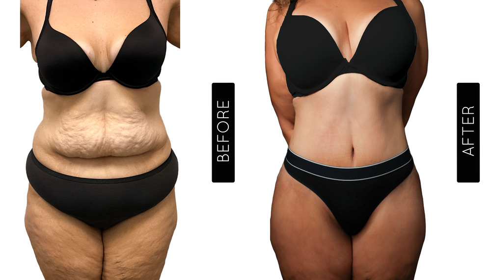 Mommy Makeover Antes y Después