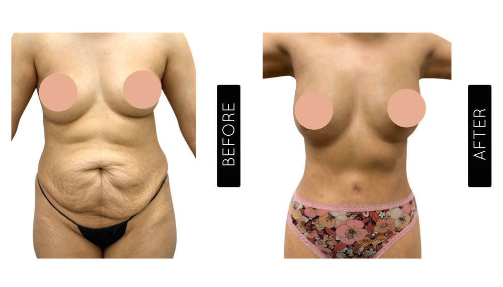 Mommy Makeover Antes y Después