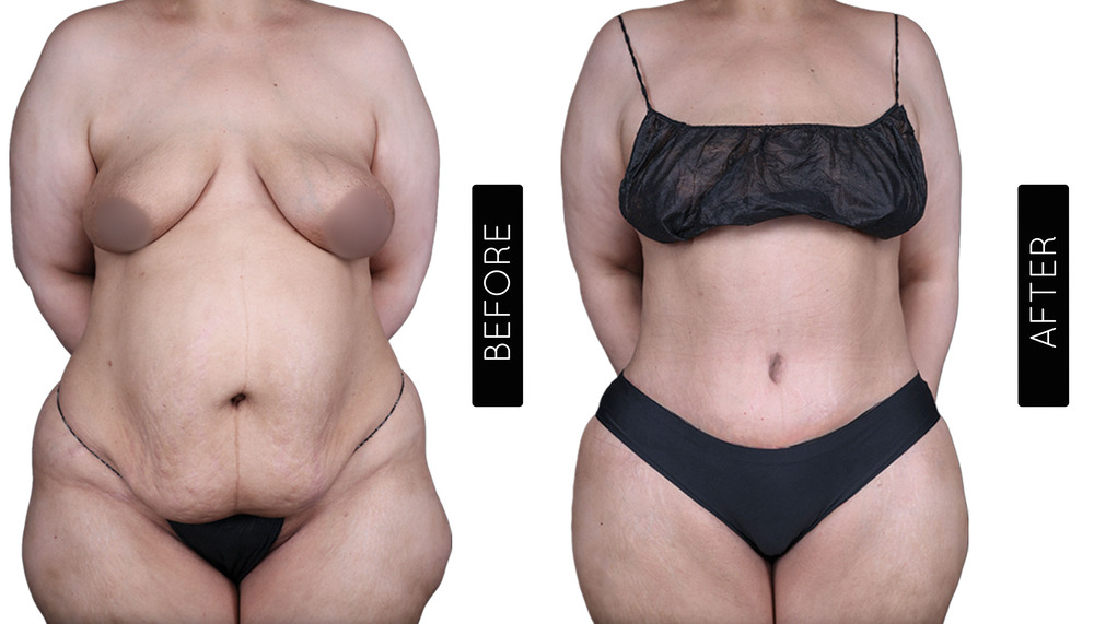 Tummy Tuck Before and After