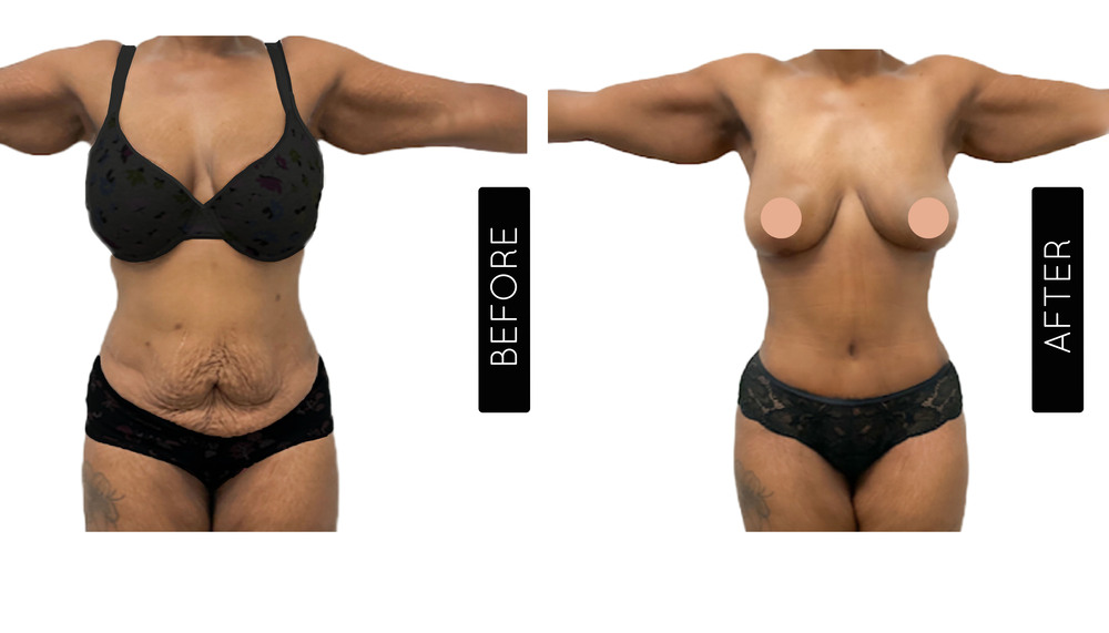 Tummy Tuck Before and After